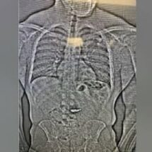 LADRÓN SE TRAGA ARETES DE DIAMANTES DE $770,000 PARA EVITAR ARRESTO EN FLORIDA