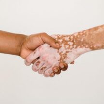VITILIGO PROVOCA BAJA AUTOESTIMA, ANSIEDAD O DEPRESIÓN