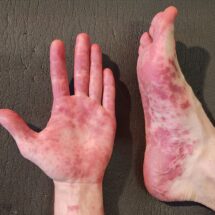 ¿Qué es el “coxsackie” que reporta Tamaulipas? aumenta en escuelas y guarderías