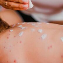 Reporta Salud 13,936 casos de sarampión y 35 muertes en México; Jalisco es el estado más afectado